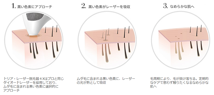 トリアで脱毛できる仕組み