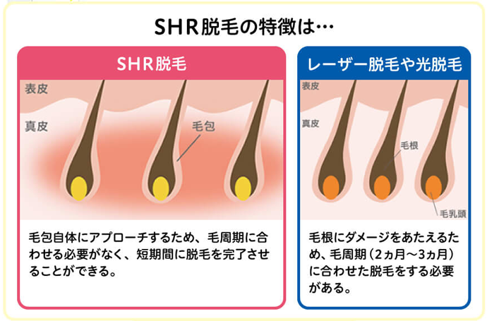 ストラッシュのSHR脱毛の説明