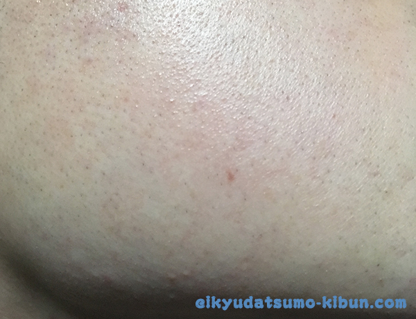 ヒゲ脱毛9回目直後頬