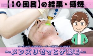 【メンズリゼ10回目終了後】ヒゲの部位ごとの脱毛結果と感想